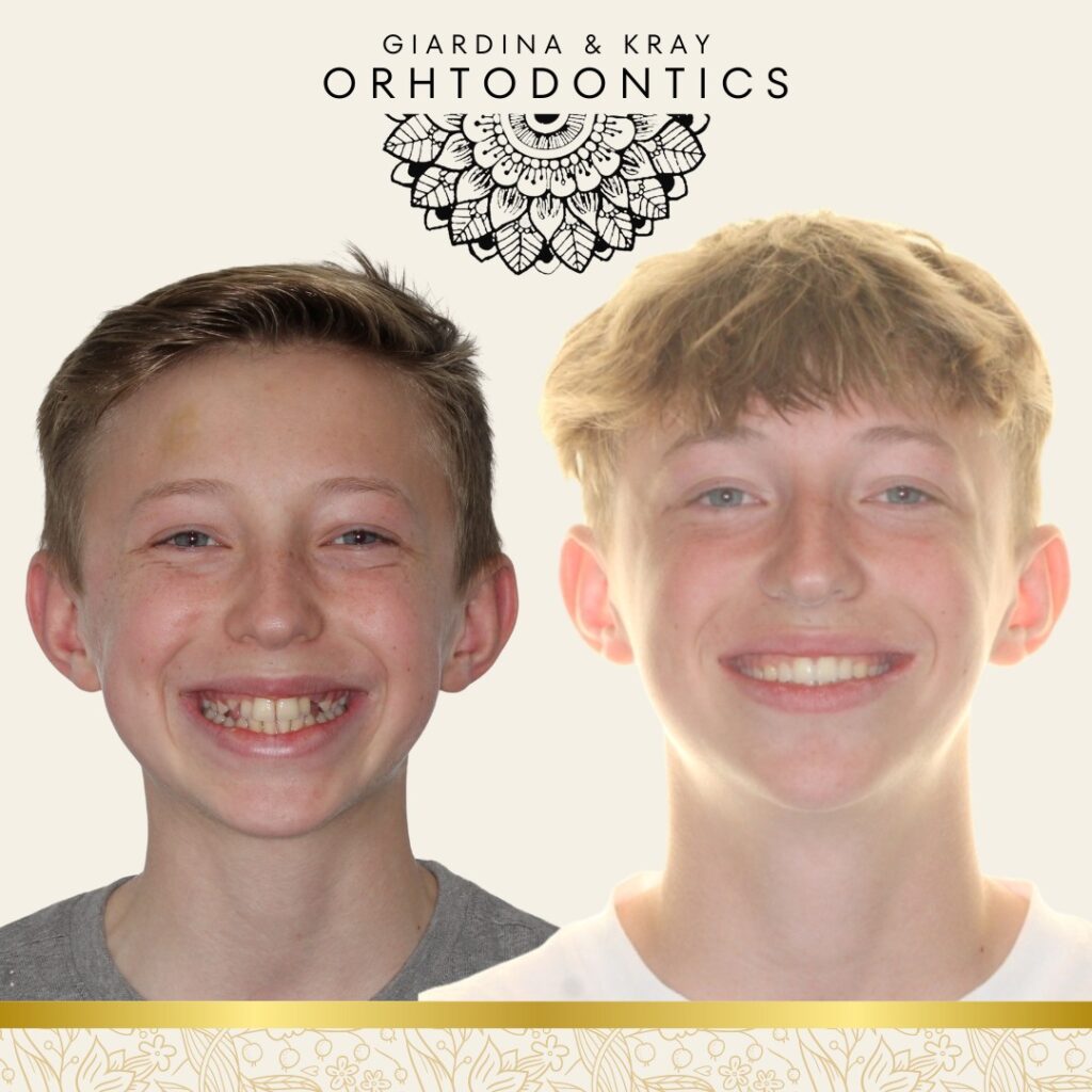 Affordable Kids' Braces in Harrisonburg