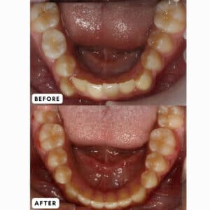 Crowded Teeth Treatment in Harrisonburg, VA at Giardina Orthodontics