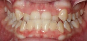 Fixing and Underbite in Harrisonburg VA