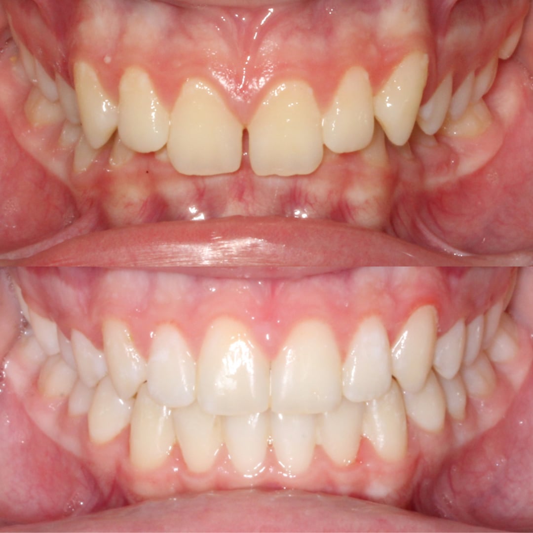 Overbite Treatment in Harrisonburg | Deep Bite Correction