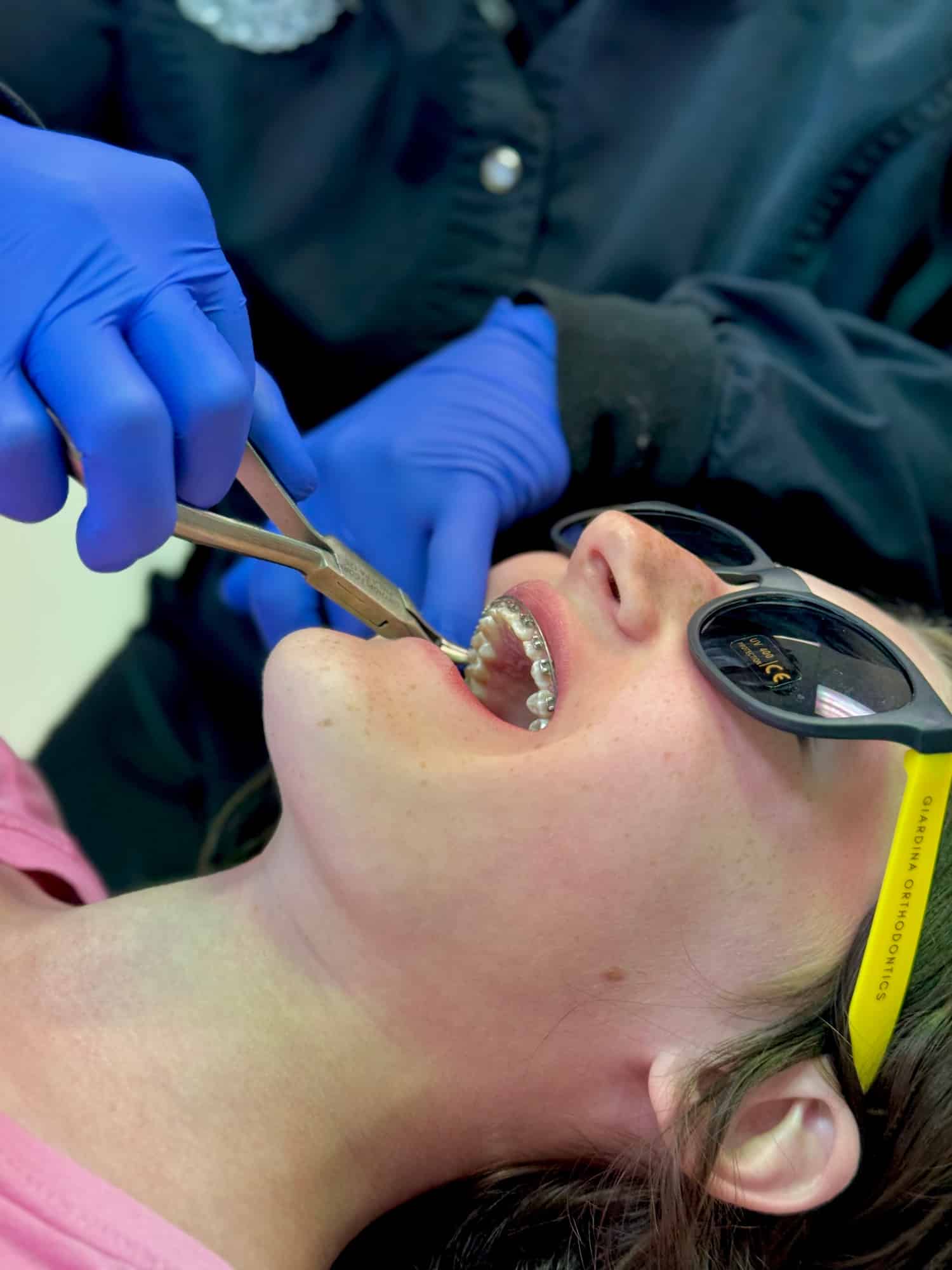 Traditional Braces vs Other Orthodontic Options