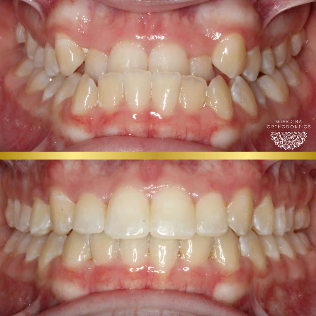 Understanding Underbites in Harrisonburg VA at Giardina Orthodontics