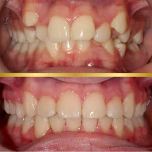 Crossbite Treatment in Harrisonburg, VA