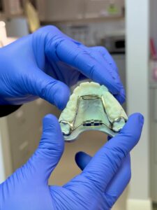 Custom palatal expander Harrisonburg VA - orthodontic appliance used by Dr Giardina for jaw expansion treatment