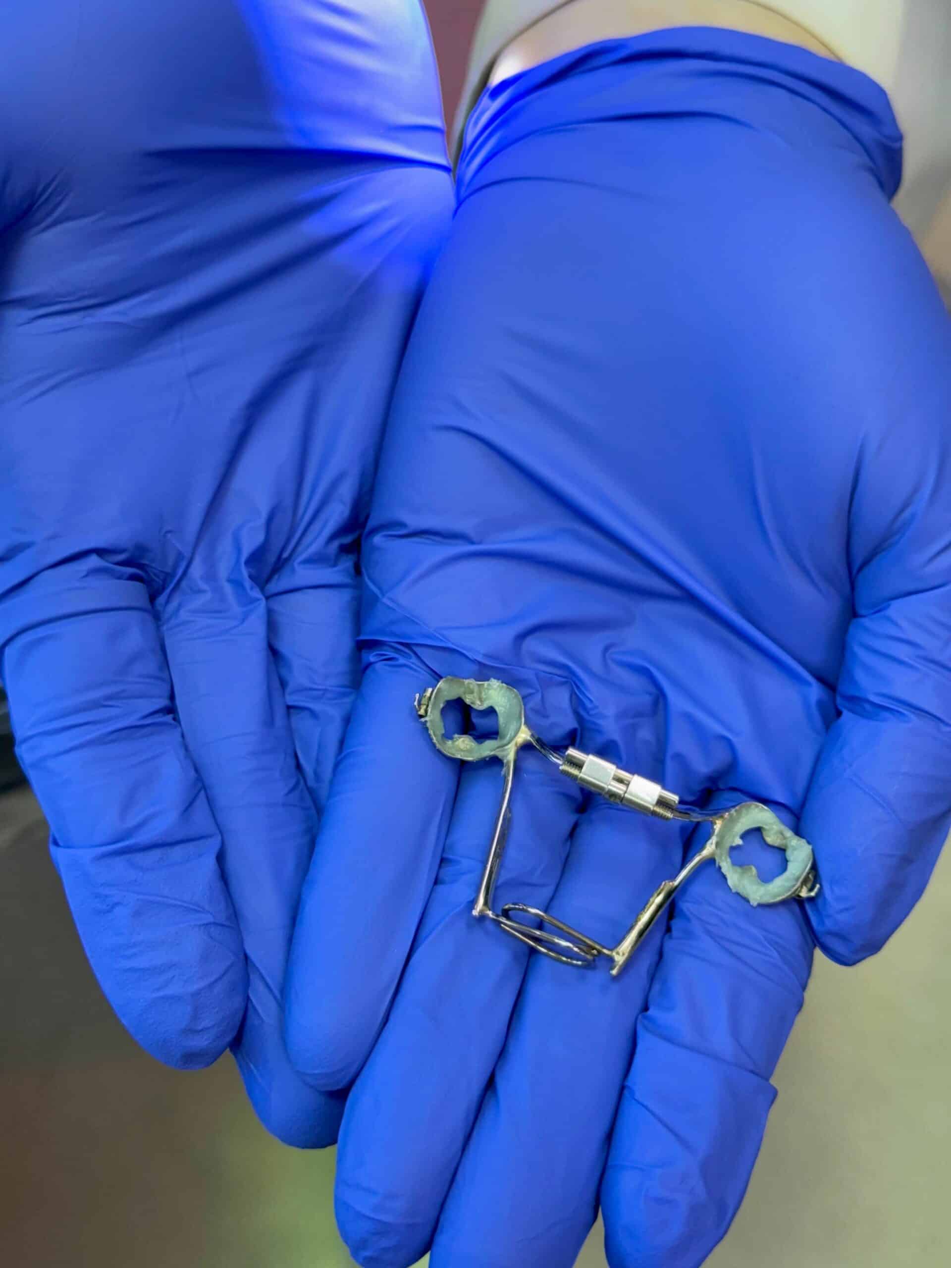 Palatal expander appliance Harrisonburg VA - orthodontic device used by Giardina Orthodontics for jaw widening
