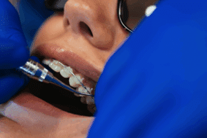Close-up of orthodontist adjusting ceramic clear braces on a patient’s teeth at Giardina Orthodontics in Harrisonburg, VA