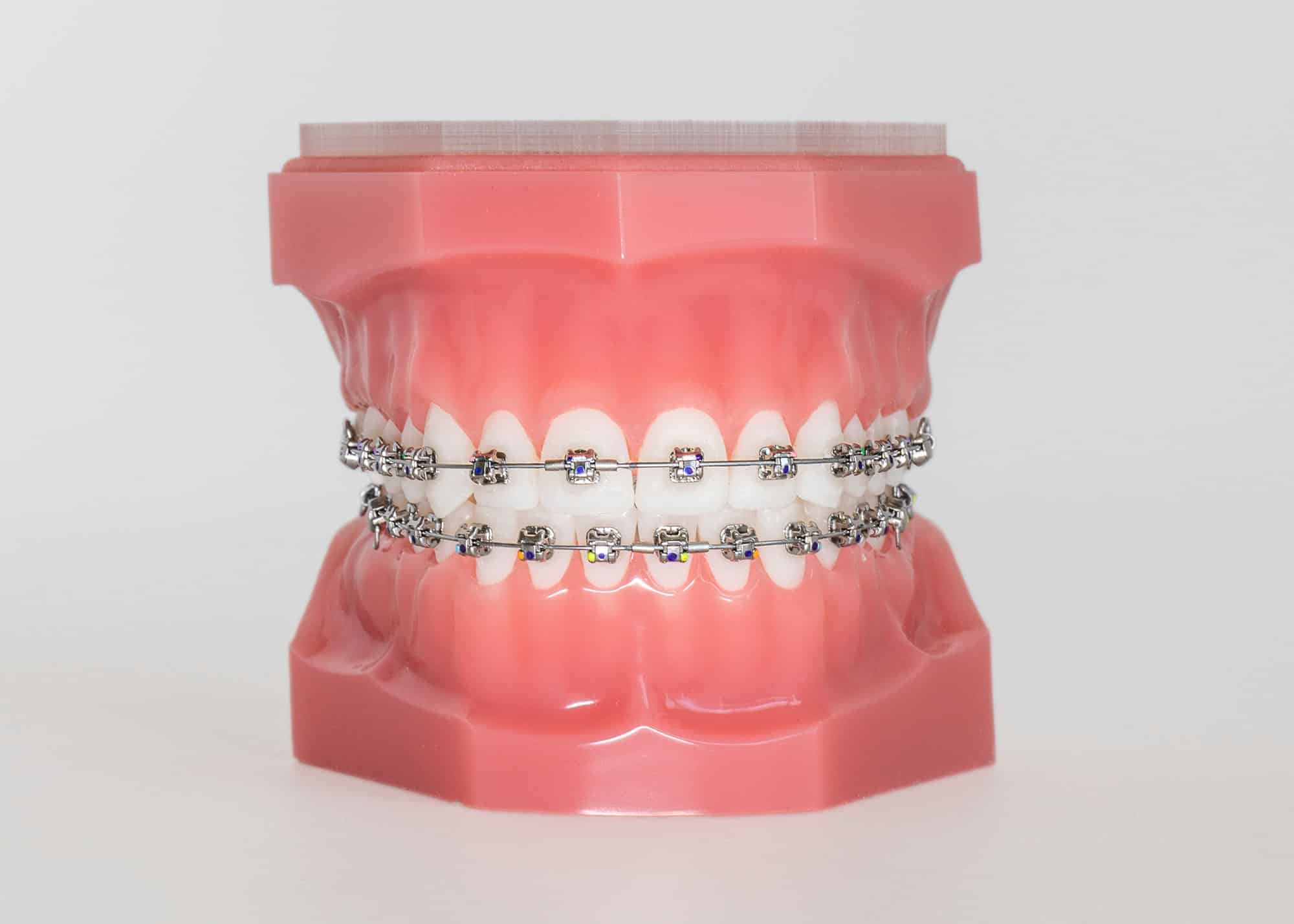 Damon self-ligating braces on dental model showing metal brackets without elastic ties at Giardina Orthodontics in Harrisonburg, Virginia