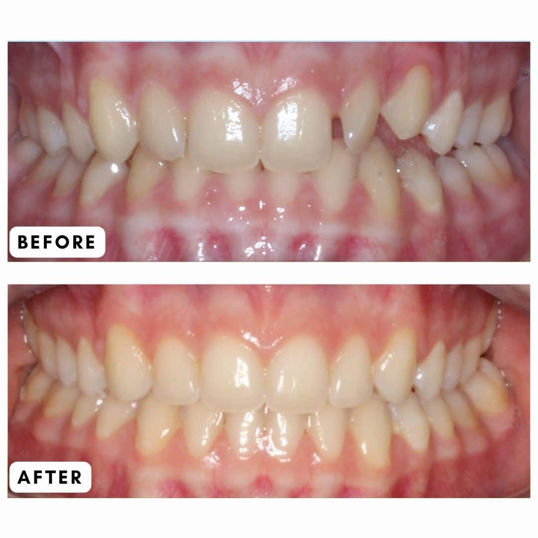 Open bite treatment in Harrisonburg, VA — Ella's before and after results showing left-side open bite corrected with braces and rubber bands at Giardina Orthodontics