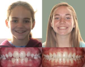 Open bite treatment in Harrisonburg, VA — Madison's before and after results with braces at Giardina Orthodontics
