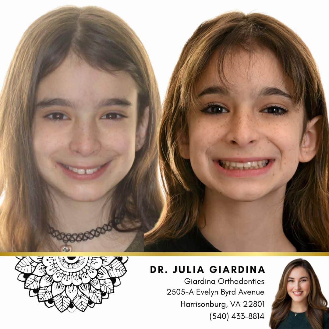 Before and after gap teeth treatment for Shayda at Giardina Orthodontics in Harrisonburg VA
