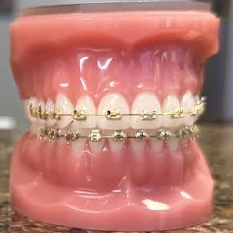 Gold braces on a dental model at Giardina Orthodontics in Harrisonburg, VA